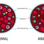 Pahami Penyakit Anemia