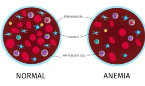 Pahami Penyakit Anemia