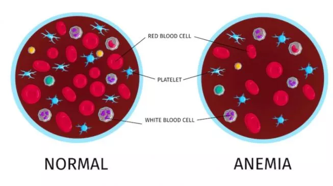 Pahami Penyakit Anemia